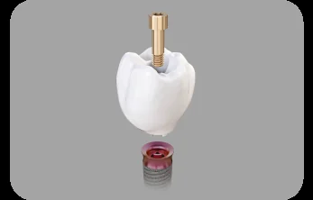 Illustration of a dental implant and crown